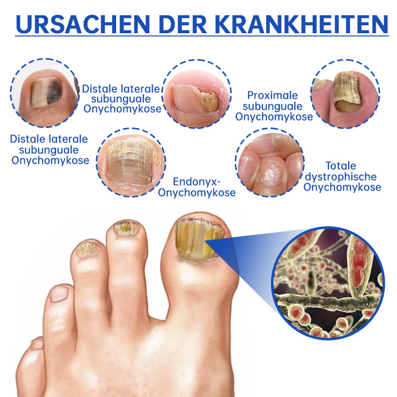 Furzero™ PureNail Pilz-Lasertherapiegerät--