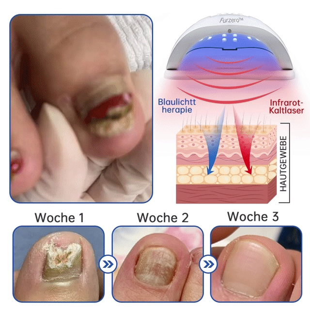 Furzero™ PureNail Pilz-Lasertherapiegerät--