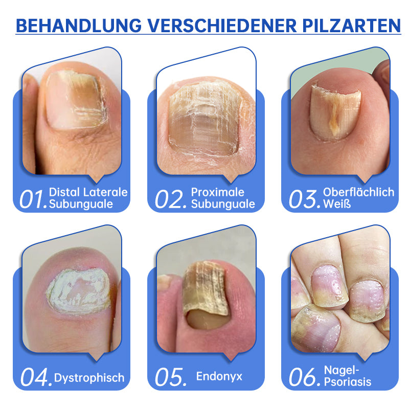 Furzero™ PureNail Pilz-Lasertherapiegerät--