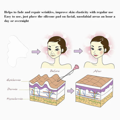 Gesichtsfaltenentferner Pad Wiederverwendbar Medizinisches Silikon Nasolabialfalten Anti-Aging Maske Verhindern Falten Haut Lifting Patches